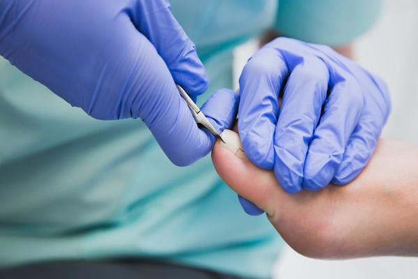 Ingrown Toenails